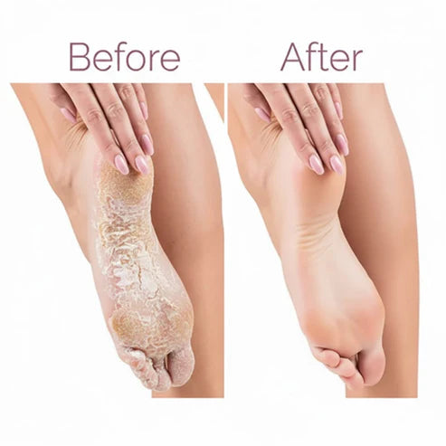 Electric Pedicure Foot File Callus Remover (مبرد قدم كهربائي لإزالة الجلد الميت والكالو)