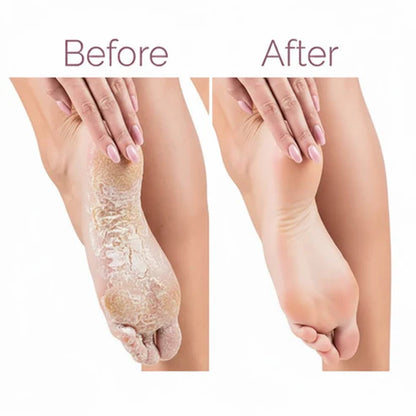 Electric Pedicure Foot File Callus Remover (مبرد قدم كهربائي لإزالة الجلد الميت والكالو)